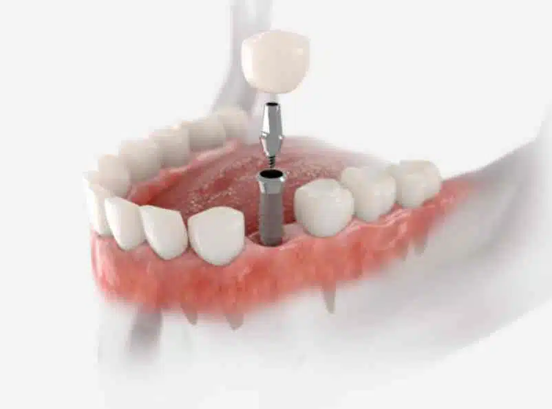 How Much Is a Tooth Implant? Dental Health Directory